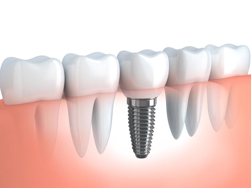 Dental Implants Iron River, MI 